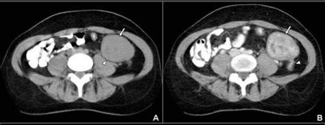 A, B. A: Axial non-enhanced CT scan at the level of aortic bifurcation,... | Download Scientific ...