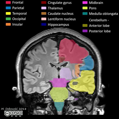 Mri Sectional Anatomy Of Brain Brain Anatomy Mri Frontal Lobe Images ...