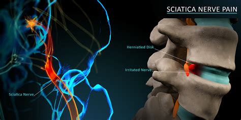 Sciatica on Behance