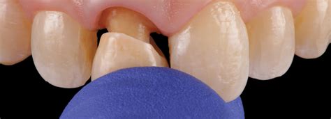 Zirconia Tooth Cap Cost in Delhi - North Delhi Dental Clinic