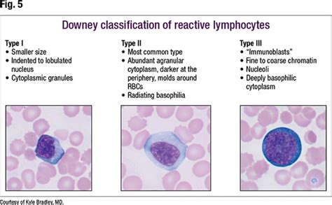 Lymphocytosis: distinguishing benign from malignant - CAP TODAY