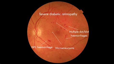 Diabetic retinopathy