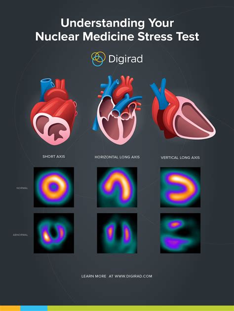 Understanding Your Nuclear Medicine Stress Test | Digirad