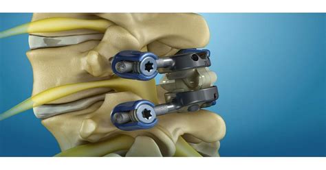 Innovations In Spine Implants Market: A Comprehensive Review | Stryker ...