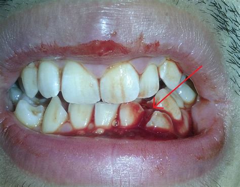 Severe bleeding gums, should I see a dentist or a doctor? [WARNING ...