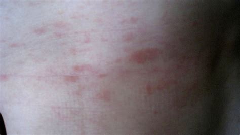 Humira Side Effects Rash - Effect Choices