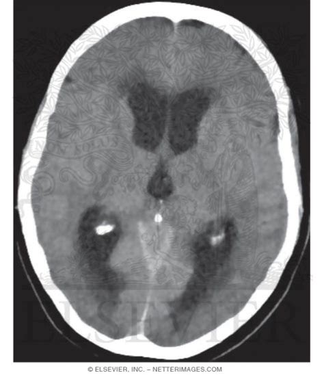 Axial CT of a Patient With Obstructive Hydrocephalus