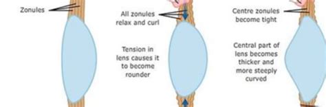 The Ciliary Body, Zonules and the Lens