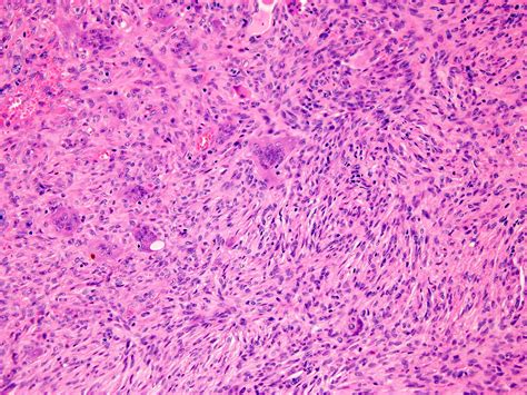 Giant Cell Tumor Histology