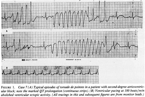 Woman with Risks for Torsades de Pointes Dying within Hours of Leaving ...