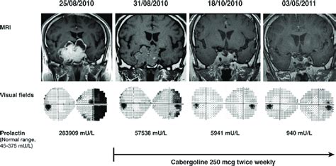 Cabergoline-induced shrinkage of a prolactinoma. Sequential MRIs, PRL... | Download Scientific ...