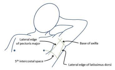 Chest Tube — Taming the SRU