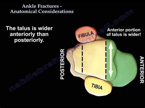 Ankle Fractures , Anatomical Considerations - Everything You Need To Know - Dr. Nabil Ebraheim ...