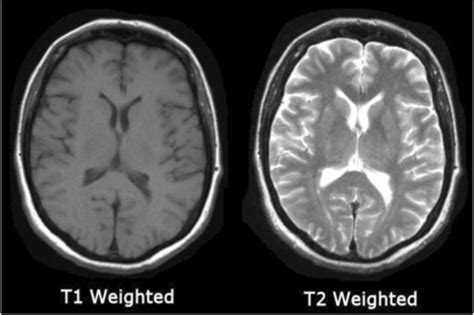 Samples of brain T1 and T2 weighted images | Download Scientific Diagram