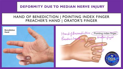 Hand of Benediction | Pointing index finger | Median nerve injury | Preacher's hand, Orator's ...