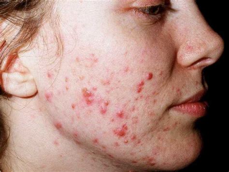 Komedone-Acne (Acne Vulgaris): Was ist das? Was hilft?