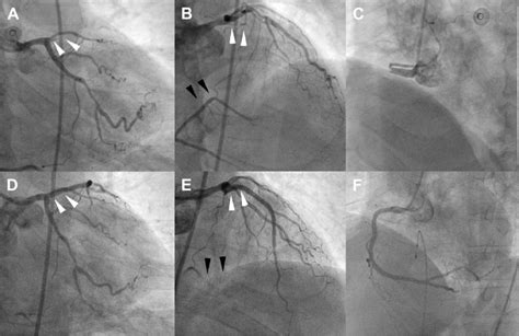 (A) Total occlusion of the left anterior descending coronary artery... | Download Scientific Diagram