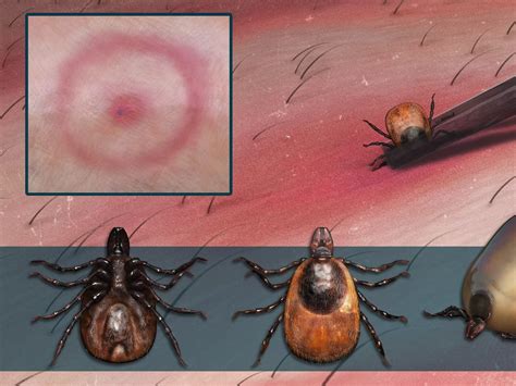 Deer ticks can cause lyme disease - here's how to identify and treat a ...