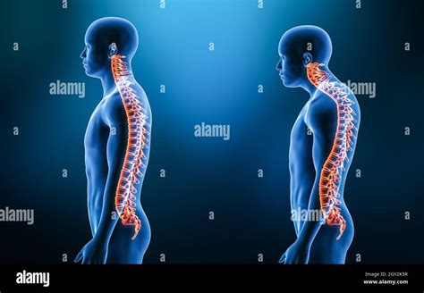 Comparison between normal curvature of the spine and kyphosis with male ...