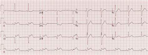 NIGHTMARES CASE 9: STEMI – EM Sim Cases