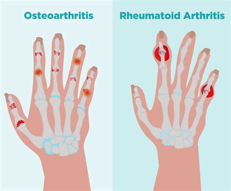 Differences Between Rheumatoid Arthritis vs Osteoarthritis