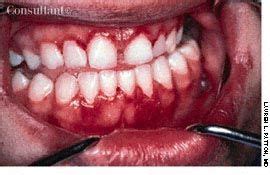 Linear Gingival Erythema