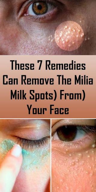 These 7 Remedies Can Remove The Milia (Milk Spots) From Your Face ...