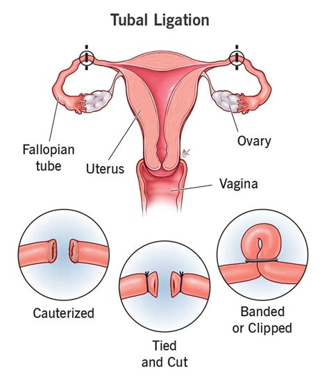 What is Tubal Ligation (Tube Ligation)? - Turkey Istanbul Medical