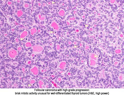 Pathology Outlines - Follicular carcinoma