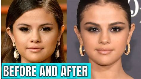 Selena Gomez: Plastic Surgery (2020) & Beauty. - YouTube