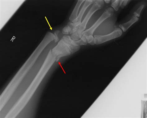 Salter-Harris fracture Type I – Radiology Cases