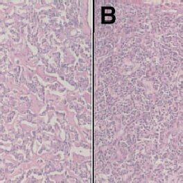 A: Histopathological apperance of insulinoma: Cells with eosinophilic ...