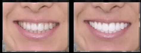 Coconut Oil Teeth Whitening How to Whiten Teeth with Coconut Oil How ...