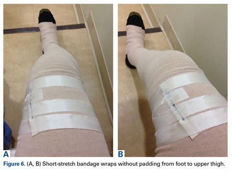 Lower Limb Morel-Lavallée Lesion Treated With Short-Stretch Compression Bandaging | MDedge Surgery