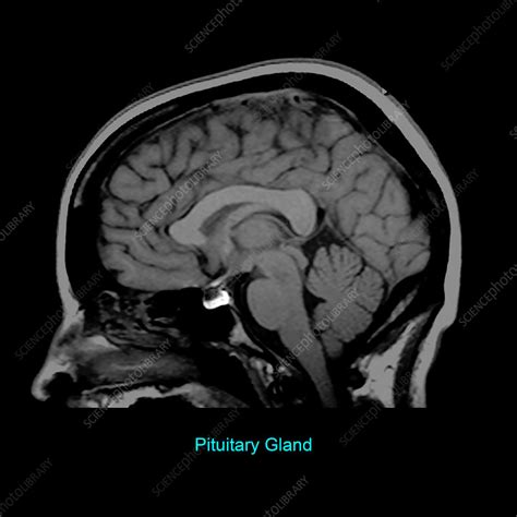 Pituitary Gland, Sagittal MRI - Stock Image - C030/6315 - Science Photo Library