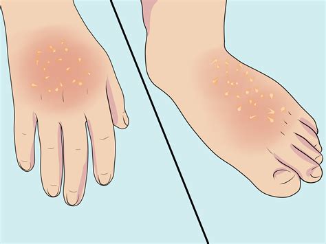 3 Ways to Diagnose Erythrodermic Psoriasis - wikiHow