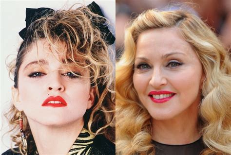 Madonna Before and After Plastic Surgery