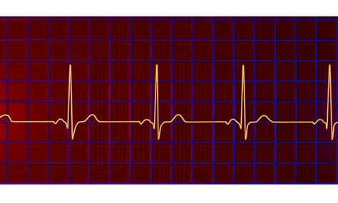 Junctional Tachycardia : Meaning , Causes , Symptoms | by Sunfox Technologies | Feb, 2024 ...