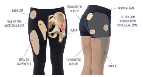 Trochanteric Bursitis | Summit Orthopedics