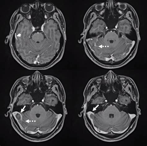 Dural Venous Channels | neuroangio.org