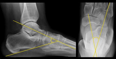 Adult with normal talocalcaneal angle, of 46º and 25º as measured on... | Download Scientific ...