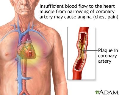 Stable angina: MedlinePlus Medical Encyclopedia