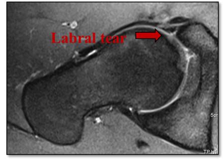 Labral Tear Hip MRI Images