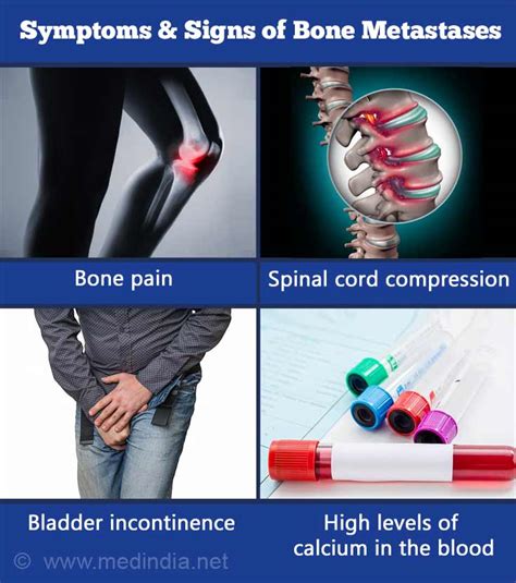 Bone Metastases | Osseous Metastatic Disease - Causes, Symptoms, Diagnosis, Treatment and Prevention