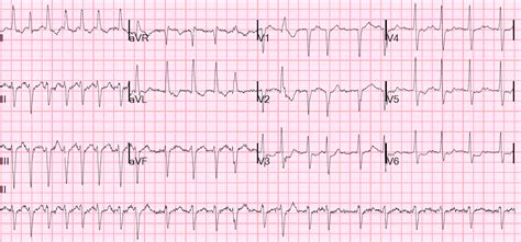 Dr. Smith's ECG Blog: Atrial Fib and RVR with a run of wide complex tachycardia. Was this ...