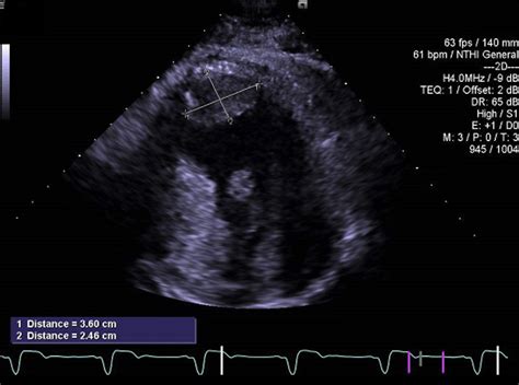 A Shocking Discovery: Apical Thrombus Formation Post–Cardiac ...