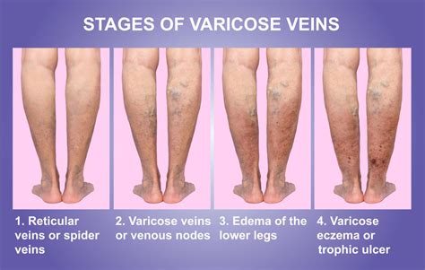 What Is the Difference between Varicose Veins and Spider Veins?