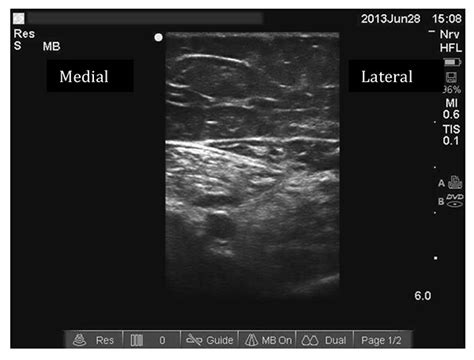 Ultrasound Guided Adductor Canal Block (Saphenous Nerve Block) : WFSA - Resources