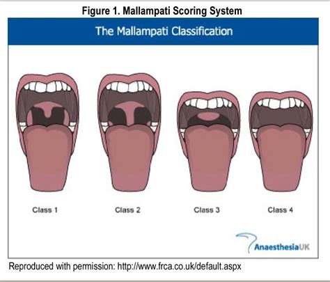 [PDF] The Relationship Between the Mallampati Scoring System, the Berlin Questionnaire, and ...