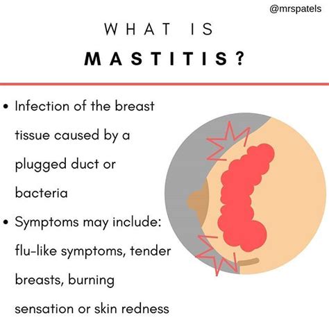 Mastitis | Breastfeeding and pumping, Breastfeeding advice ...